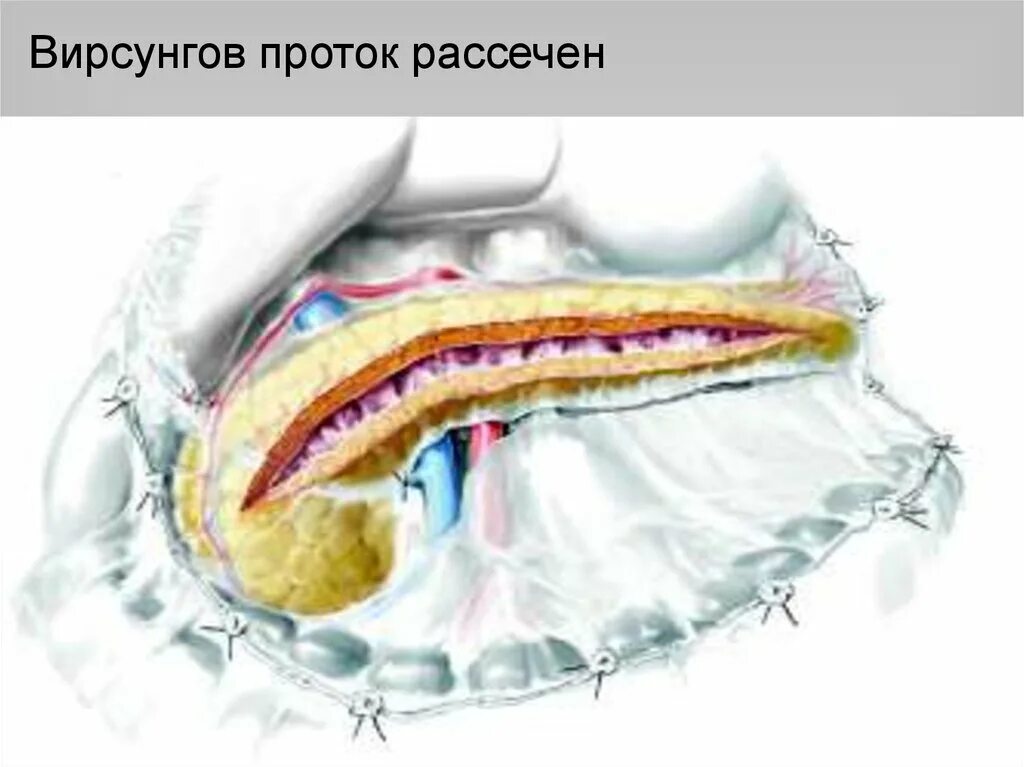 Вирсунгов проток это. Расширенный вирсунгов проток. Расширение вирсунгова протока на кт. Расширении вирсунгов протока.