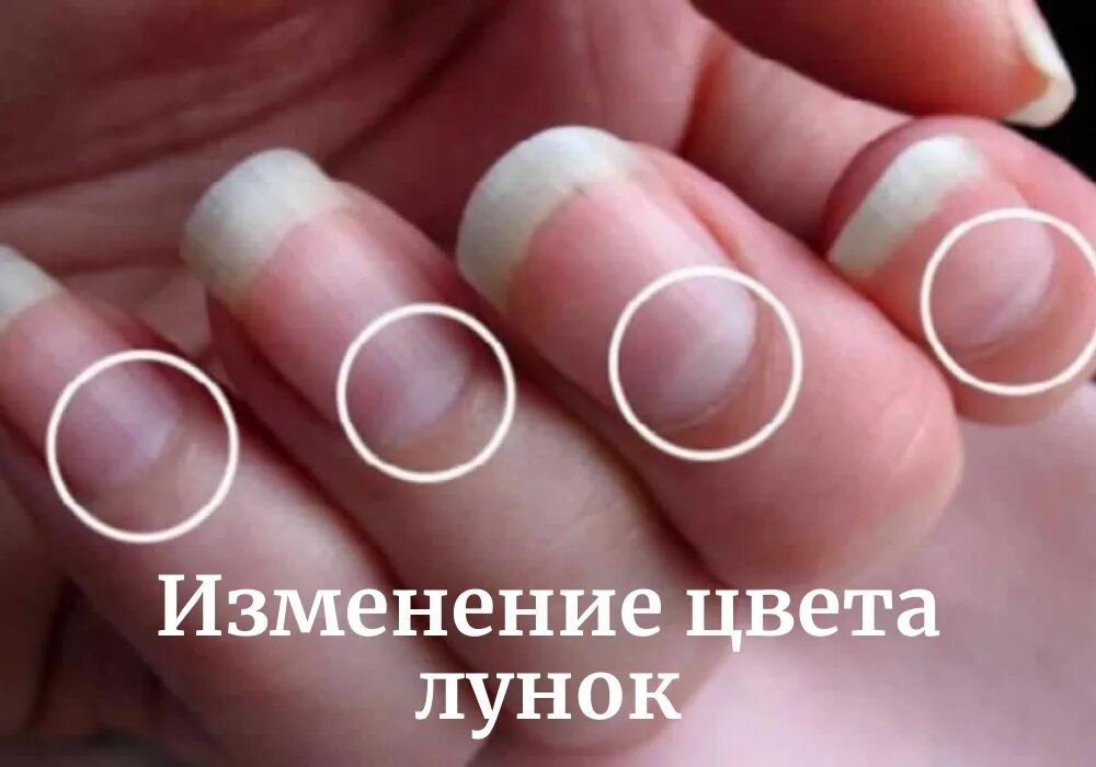 Почему исчезли лунки на ногтях. Нормальные лунки на ногтях. большие лунулы на ногтях.