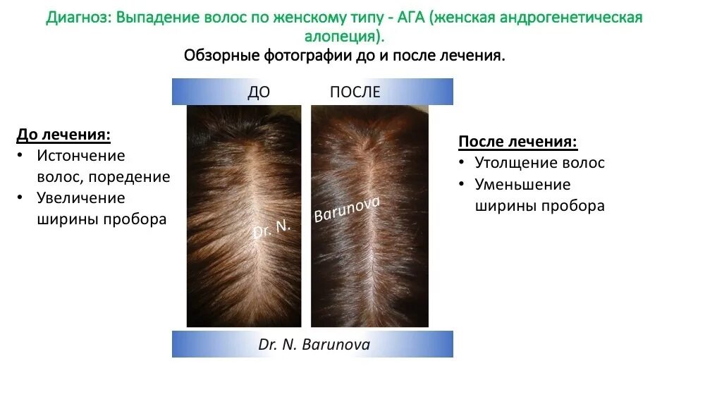 Структура здорового волоса. Процесс выпадения волос. Выпадение волос алопеция. Признаки сильных волос
