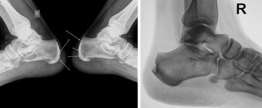 Tratamiento de los pies charcot Muy Fitness Sprained ankle, Sprained ankle exerc