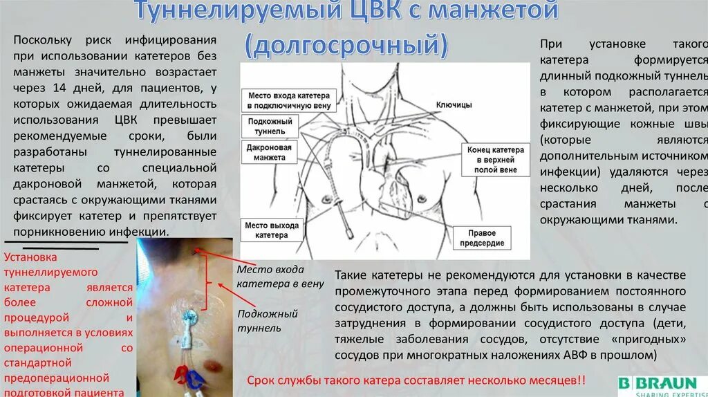 Подключичный венозный катетер. Центральный венозный катетер. Подключичный катетер для гемодиализа. ЦВК Центральный венозный катетер. Через легкие удаляются