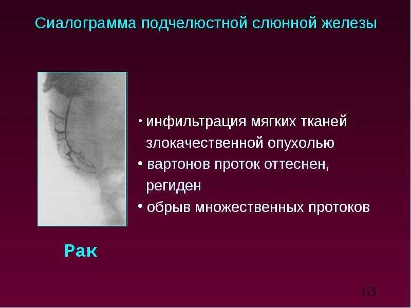 Злокачественные опухоли слюнных желез нмо: найдено 82 изображений
