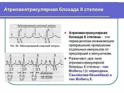 Блокада сердца 2 степени