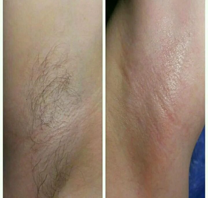 Депиляция ноги подмышки. Воск для депиляции. Восковая депиляция. Лазерная эпиляция. Эпиляция под.