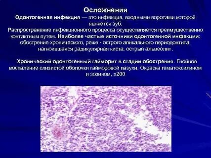 Очаговая хроническая инфекция