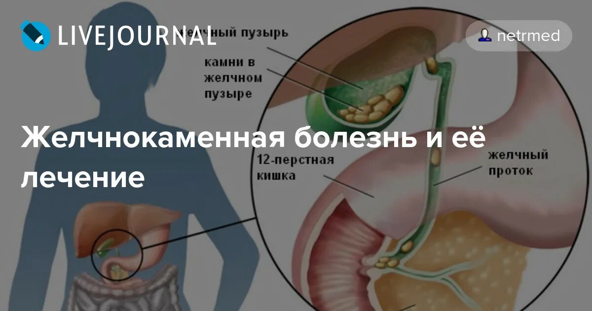 Болит желчный пузырь причины. Желчный пузырь желчнокаменная болезнь. Симптомы при камнях в желчном пузыре. Камень в протоке желчного пузыря. Желчный пузырь при ЖКБ.