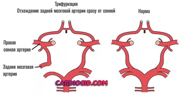 Правая задняя трифуркация. Задняя трифуркация внутренней сонной артерии мрт. Варианты развития передней мозговой артерии. Виллизиев круг передняя трифуркация. Передняя трифуркация левой внутренней сонной артерии.