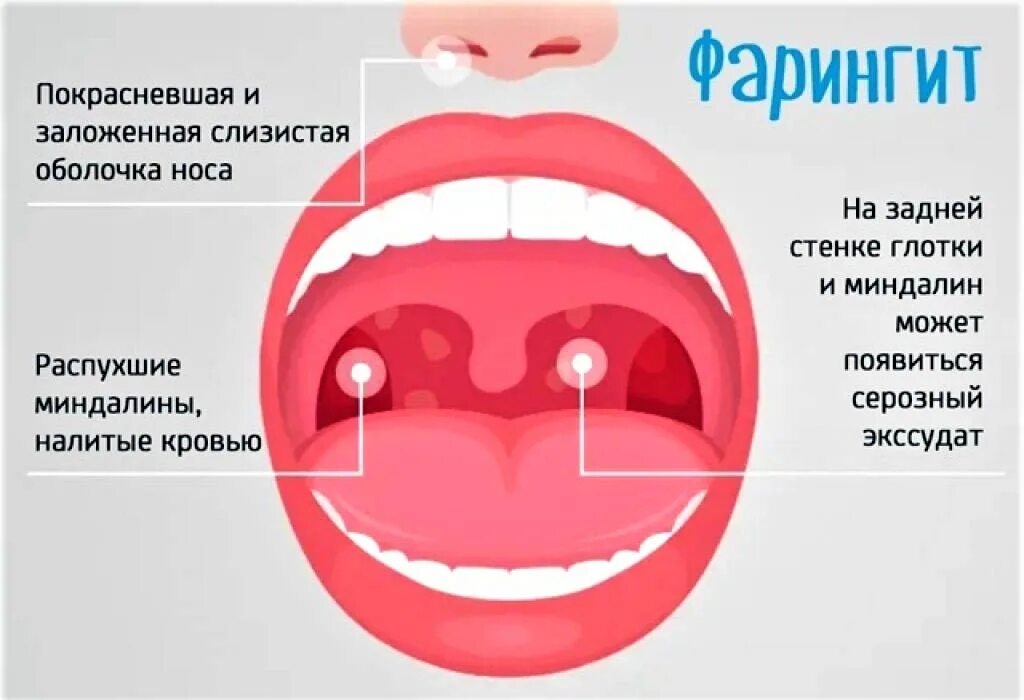 Горло сильно болит чем лечить у взрослого. Герпесвирусная ангина.