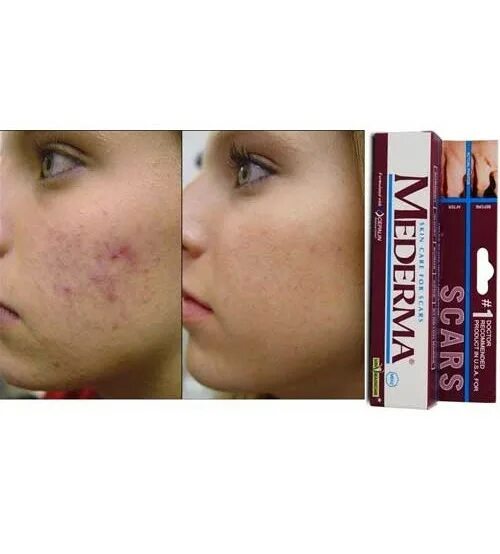 Печать радогона от шрамов. Крем acne scar removal от прыщей. Лазерная шлифовка со2 акне. Elden ring печать. Bioaqua anti acne крем.