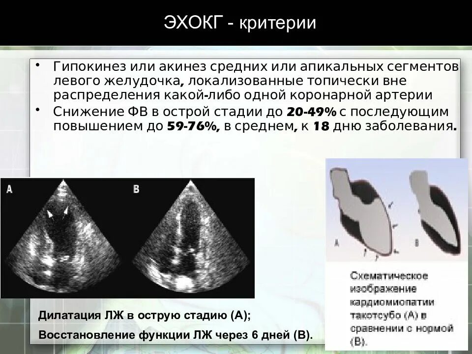 Гипокинез базального сегмента. Гипокинез сегментов левого желудочка. дкмп эхокг критерии. кардиомиопатии на эхокг. сегменты сердца эхокг.