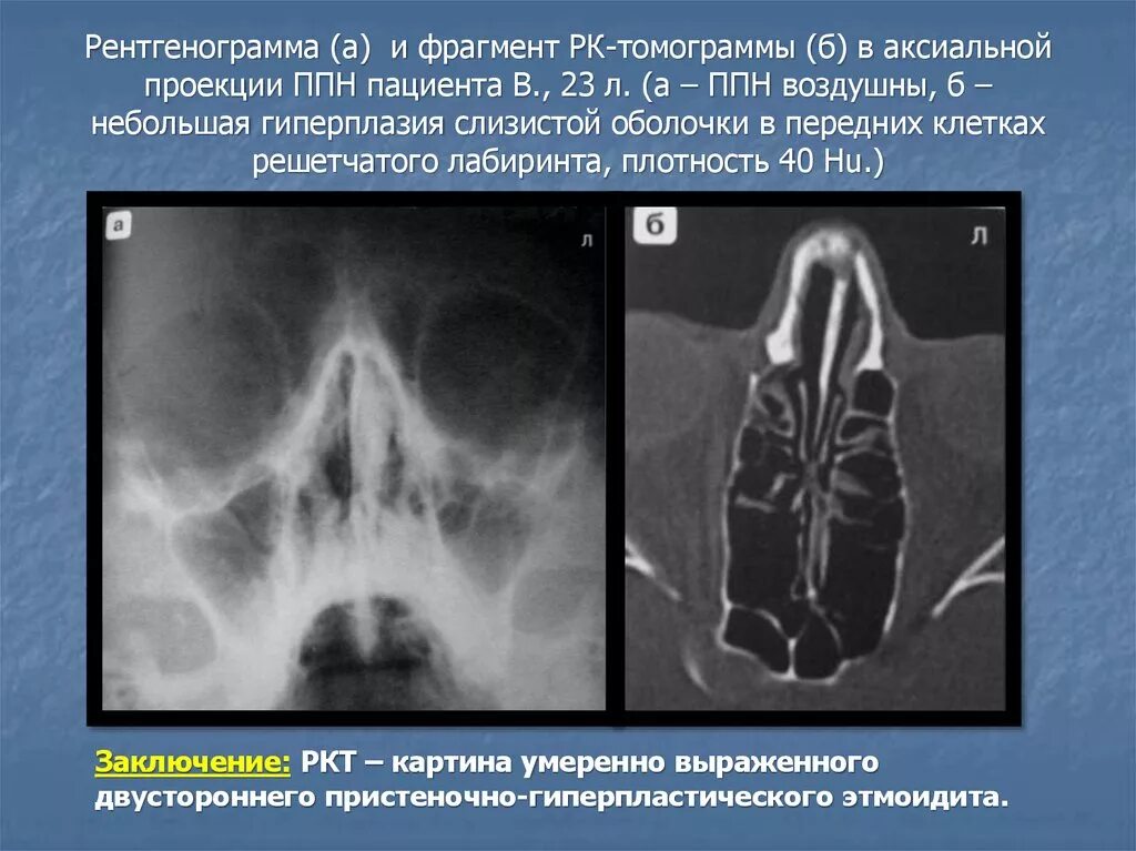 Пристеночное утолщение слизистой оболочки. Рентген носовых пазух этмоидит. Решетчатые пазухи носа рентген. Решетчатая пазуха рентген. Рентгенограмма придаточных пазух носа.