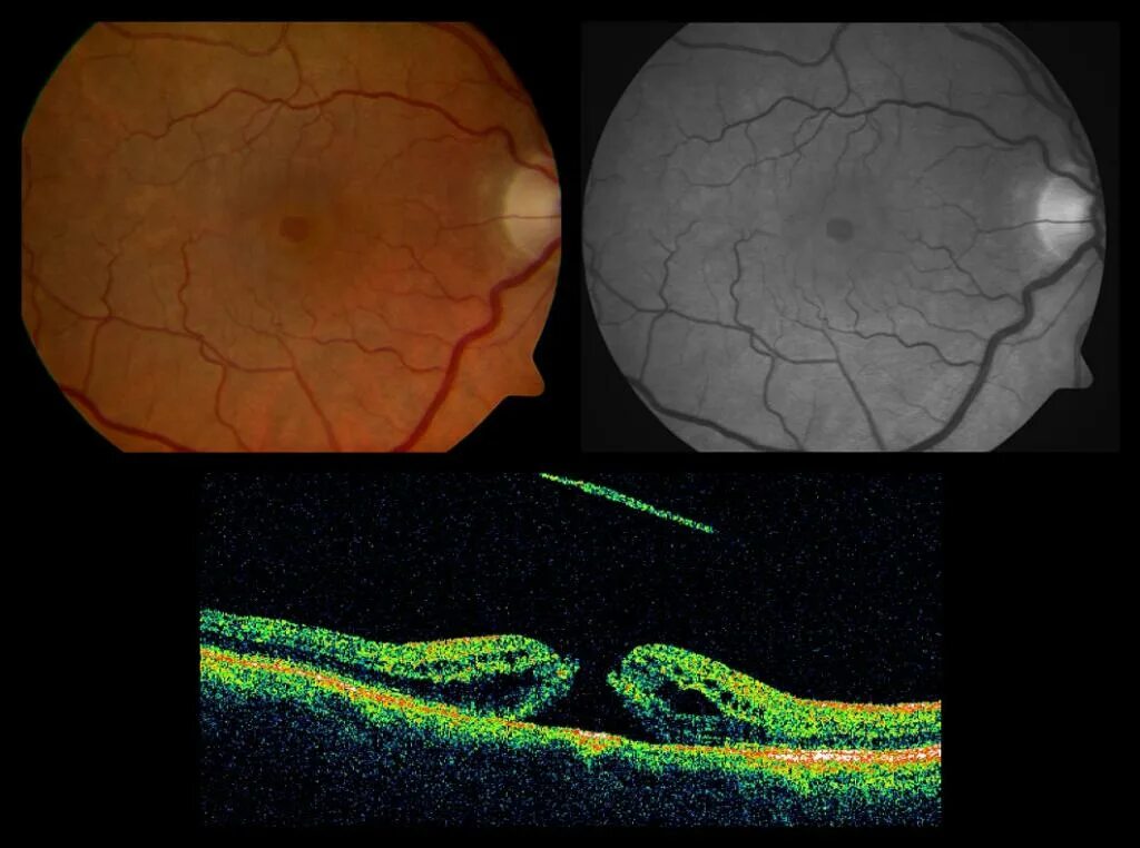 Регматогенная отслойка сетчатки. Пузыревидная отслойка сетчатки. Воронкообразная отслойка сетчатки. Неопластическая отслойка сетчатки. Повреждение сетчатки