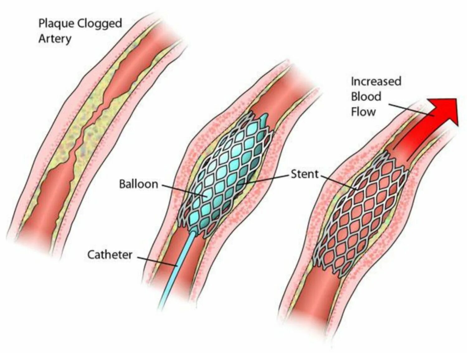 Система стента. Стент SUPRAFLEX. Стент Xience. Стент-графт сосудистый.