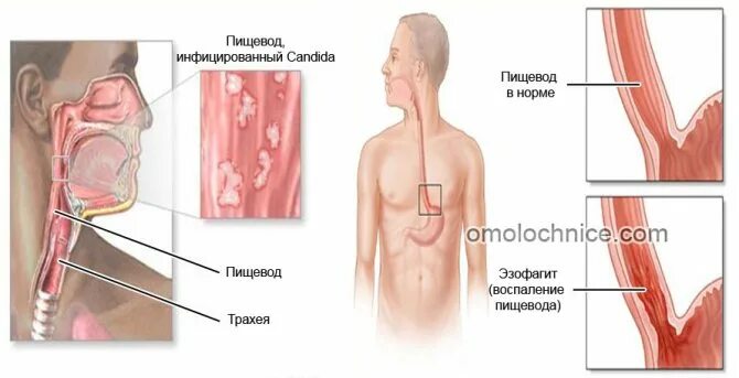 Как вылечить пищевод. Гастроэзофагеальный кандидоз. Кандидозный эзофагит 2 ст. Язвенный эзофагит гистология.
