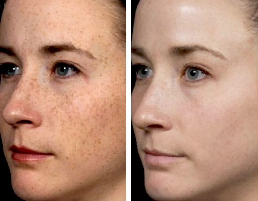 Пигментация на лице до и после. Проблемная кожа до и после. Spotted skin