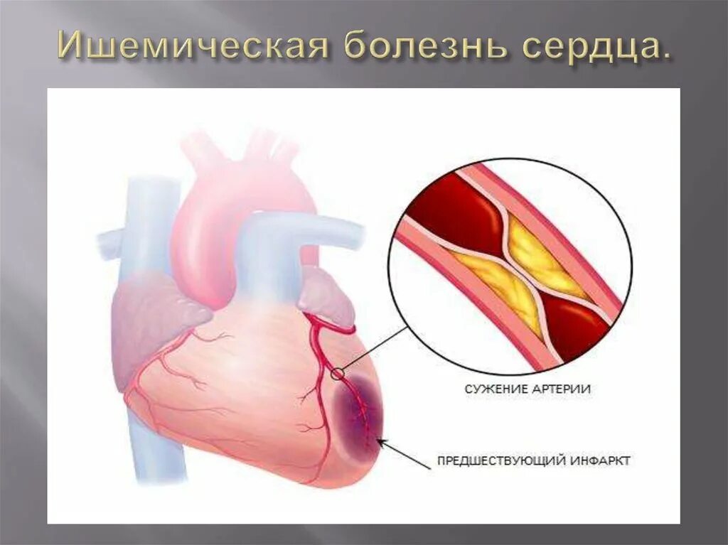 Тяжелая ишемия