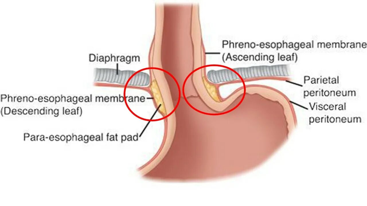 Пролапс желудка в пищевод. Угол Гиса и клапан Губарева. Мембраеа Лаймена-Бертелли. Мембрана Лаймера-Бертелли. Клапан Губерова.