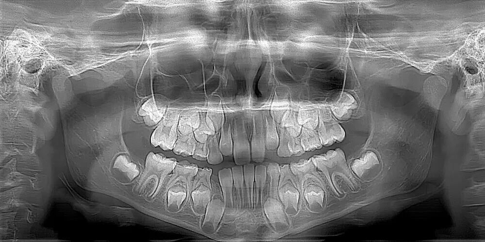 Deciduous Tooth X Ray: изображения, стоковые фотографии и векторная графика Shut