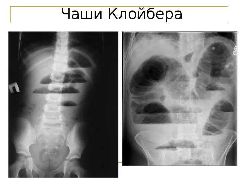 Рентген чаши клойбера. Чаши клойбера на рентгенограмме. При кишечной непроходимости на рентгене чаши. Рентген кишечника чаши клойбера. Кишечная непроходимость рентген тонкокишечная.