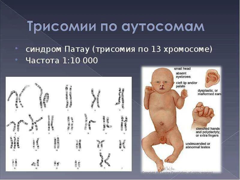 Отклонения хромосом у человека. Хромосомные болезни человека примеры. Кариотип больного с синдромом патау. Отклонения хромосом у человека. Синдром тернера (моносомия х хромосомы).