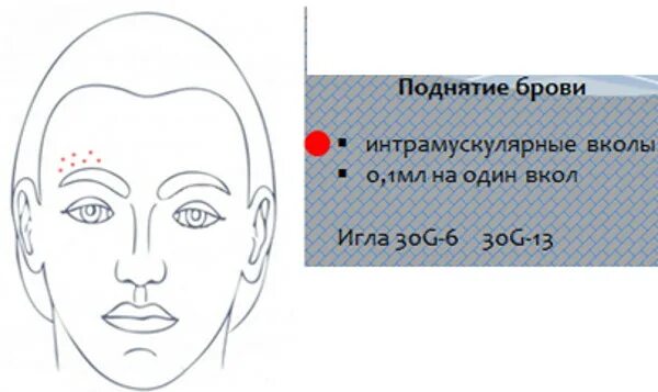 Схемы инъекций ДМАЕ. Схема мезотерапии ДМАЕ. ДМАЕ схема введения лицо. Мезотерапия ДМАЕ схема введения.