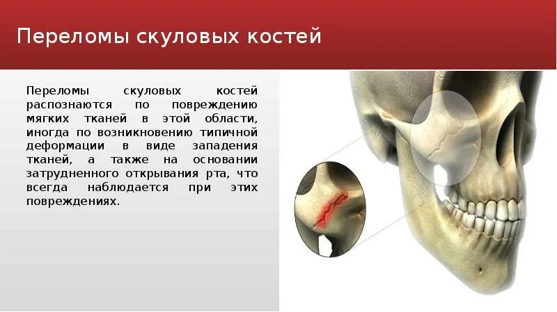 Перелом таранной кости рентген. Скуловая дуга верхней челюсти. Прочные кости. Перелом беннета 1 пястной кости. Какие кости легко сломать.