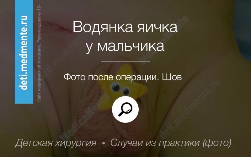 Водянка яичка до и после операции Кому проводили операцию водянка на яичке у ребенка фото презентация