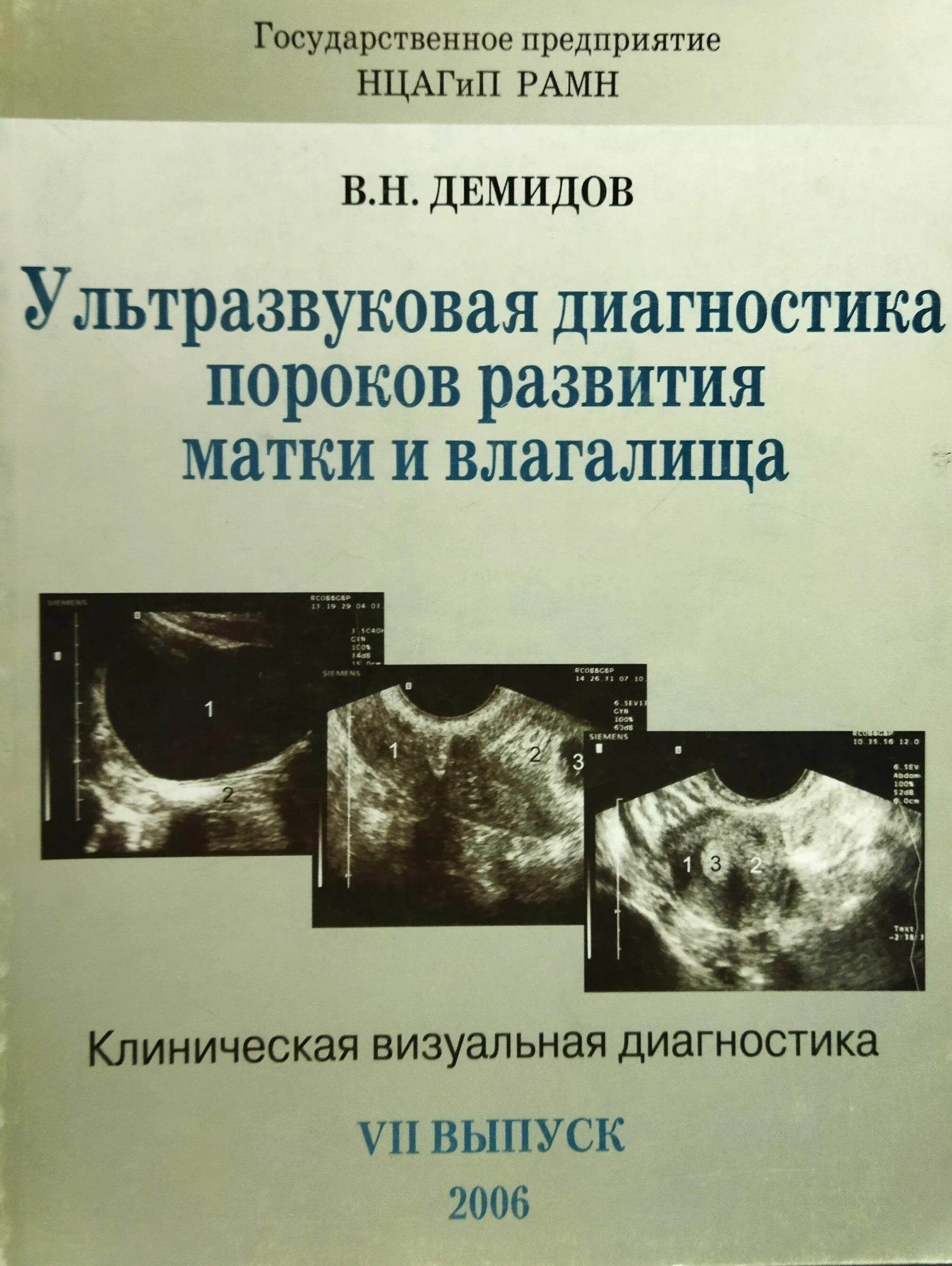 Ультразвуковая диагностика книги. Ультразвуковая диагностика дефектов. Пороки развития матки УЗИ. Порок развития матки и влагалища диагностика.