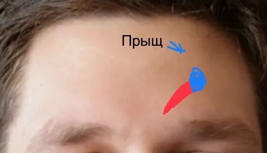 Прыщ над левой бровью примета. Прыщ с припухлостью на лбу. прыщ на лбу над правой бровью.