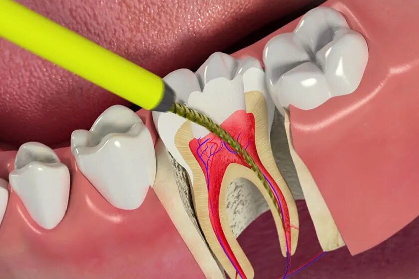 Пульпит пломбировка каналов.