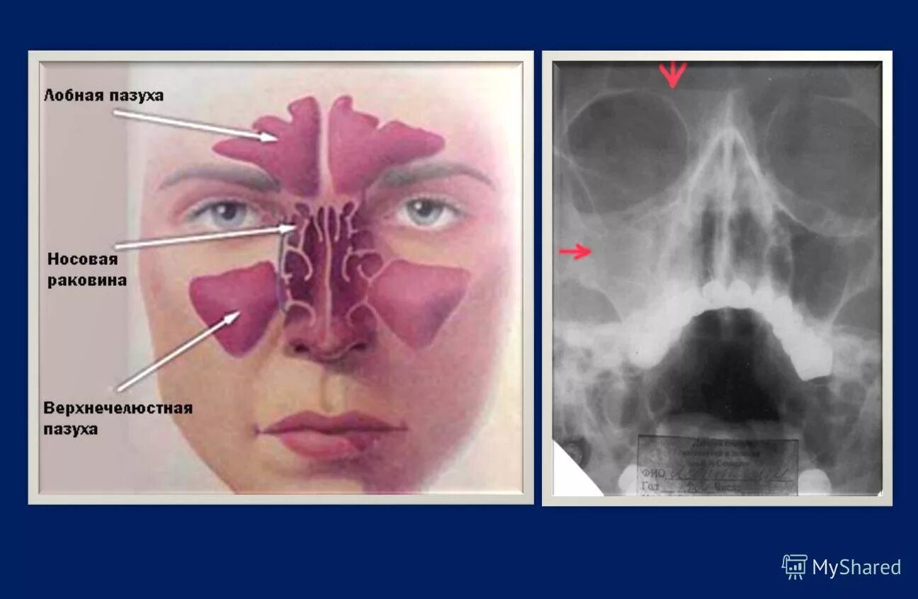 Гайморит носа. Пазухи носа анатомия гайморит. Носовая полость гайморовы пазухи строение. Гайморовы пазухи анатомия гайморит. Гайморовы и лобные пазухи.