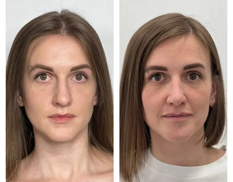 Русецкий ринопластика. Септоринопластика бабаян. Ринопластика грандмед. Пластика носа. Риносептопластика операция.