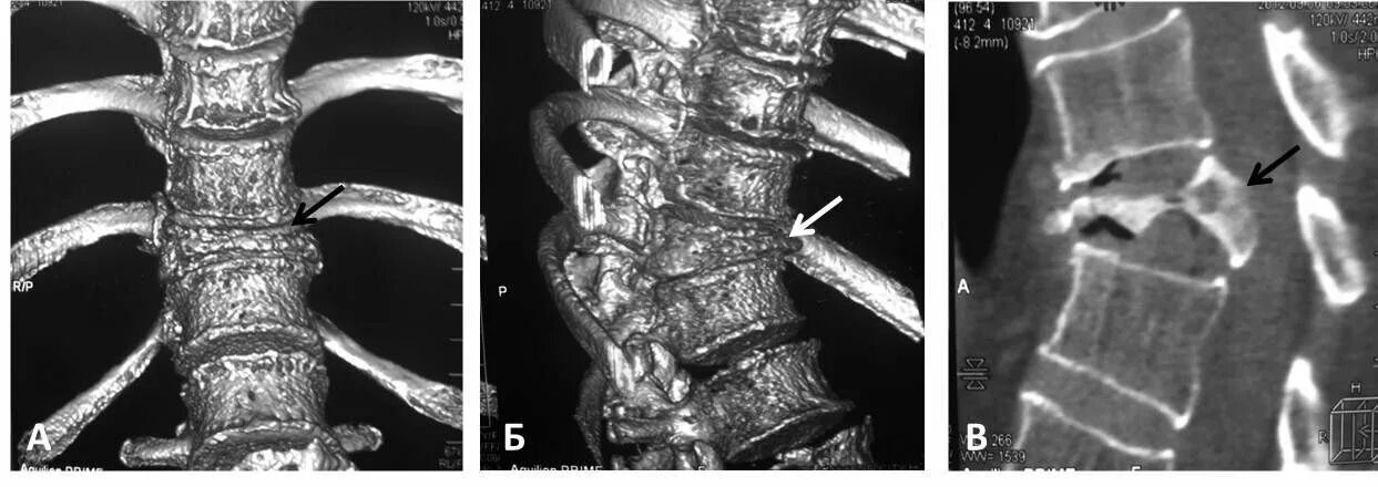 Компрессионный перелом позвоночника th11. Компрессионный перелом позвонков мрт. Компрессионный перелом позвоночника 11 позвонка. Компрессионный перелом грудного позвонка мрт. Операция смещение позвоночника