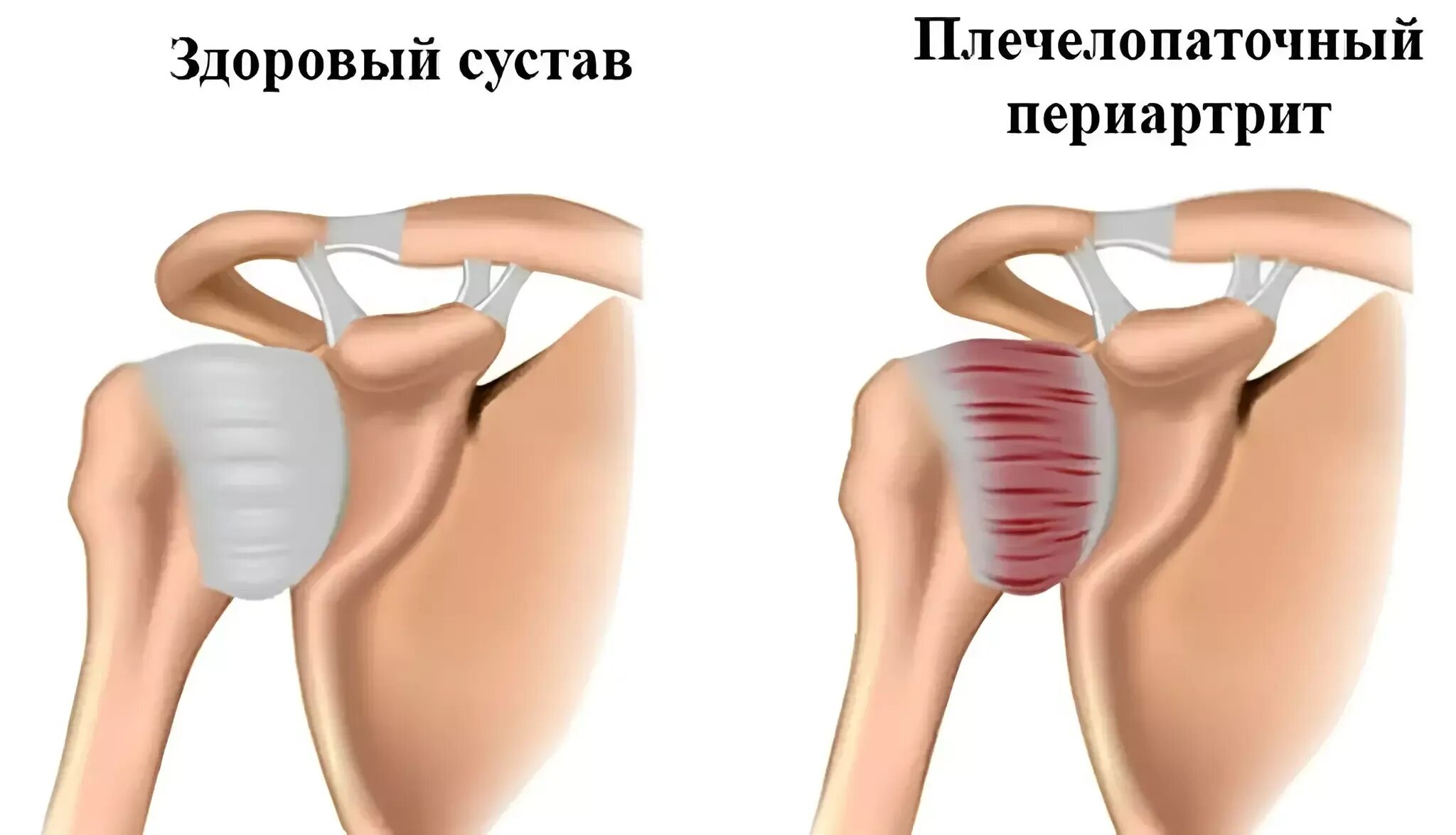 Эффективное лечение плечевого сустава. Адгезивный капсулит плечевого сустава рентген. Лопаточно-плечевой периартрит. Капсулит замороженное плечо. Адгезивный капсулит плеча симптомы.