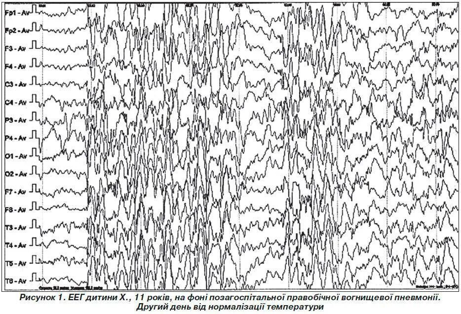Диффузная активность мозга. Нормальная диаграмма ЭЭГ. ЭЭГ пароксизмальная активность пик волна. ЭЭГ норма и патология. Норма Альфа ритма головного мозга при ЭЭГ У ребенка.