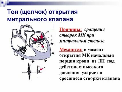 Тоны клапанов