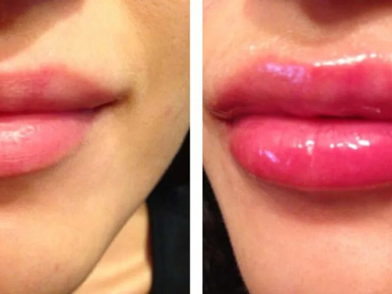 Губы после контурной пластики. 0.5 в губы до и после фото