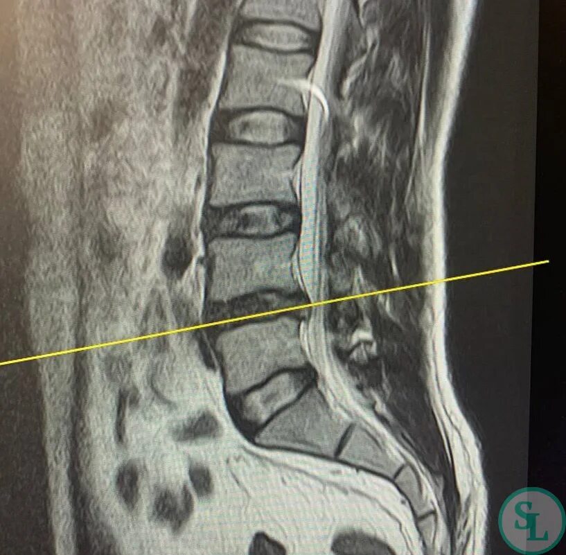 Позвоночник отдел l3 s1. Грыжи Шморля l4 l5. Грыжа Шморля l1-l5 s1. Грыжи Шморля l1 l2 l3 l4. Грыжа дисков l2- 3, l3-4,l4-5, l5-s1.