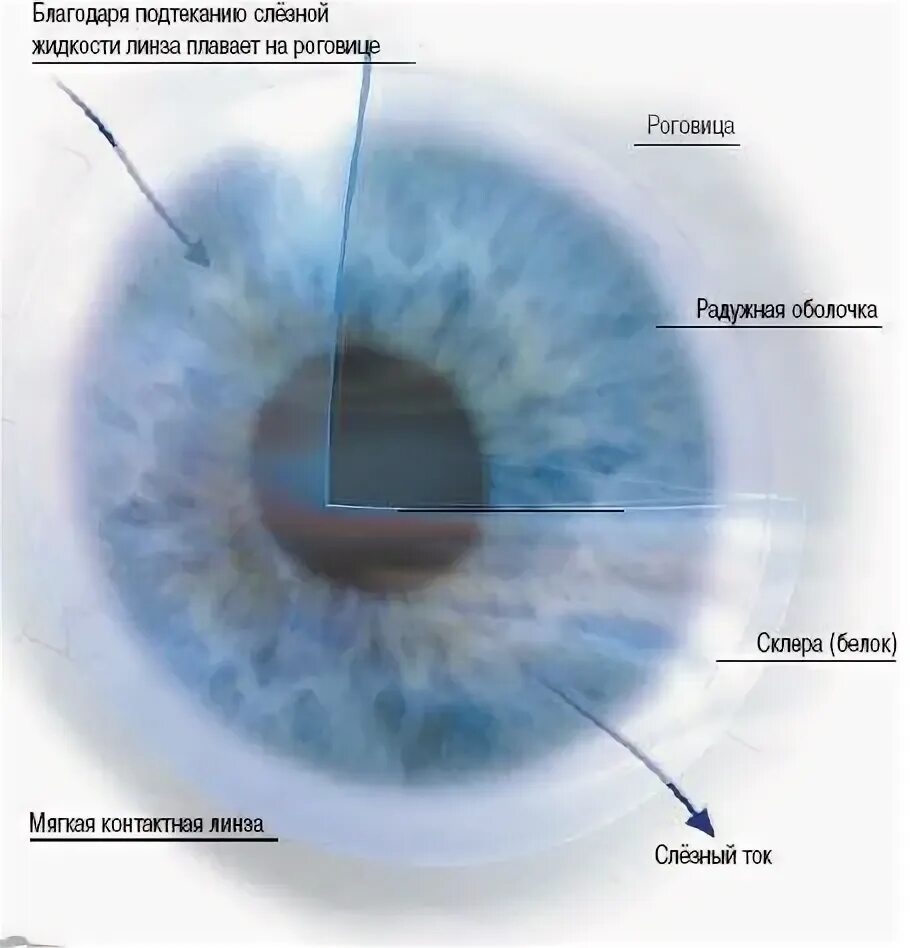 Контактная линза на роговице. Отложения на контактных линзах. Отложения на роговице контактных линз. Белковые отложения на контактных линзах. Можно плавать в линзах