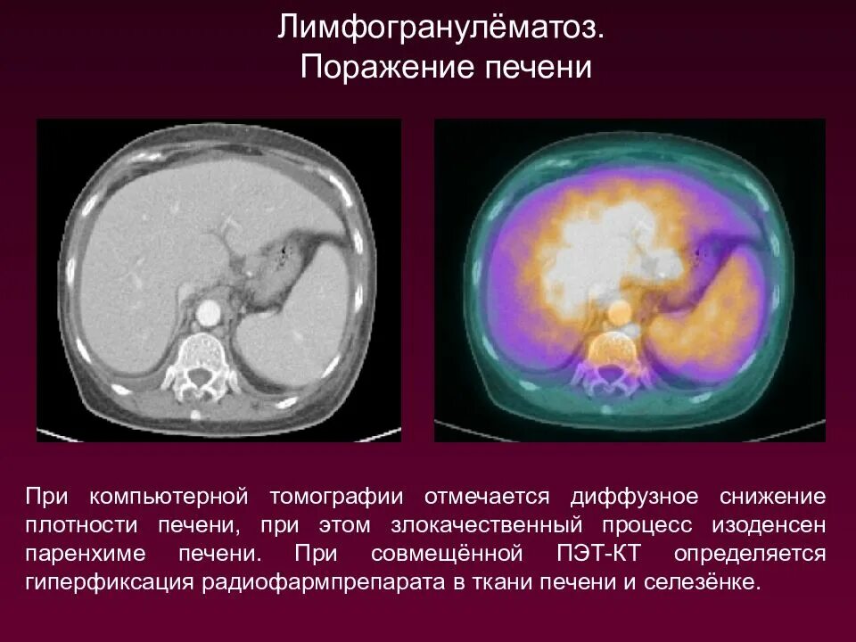 Плотность паренхимы печени снижена что. Пэт кт при лимфоме ходжкина. поражение печени при лимфоме ходжкина на кт. поражение печени при лимфоме кт. диффузное снижение плотности печени на кт.