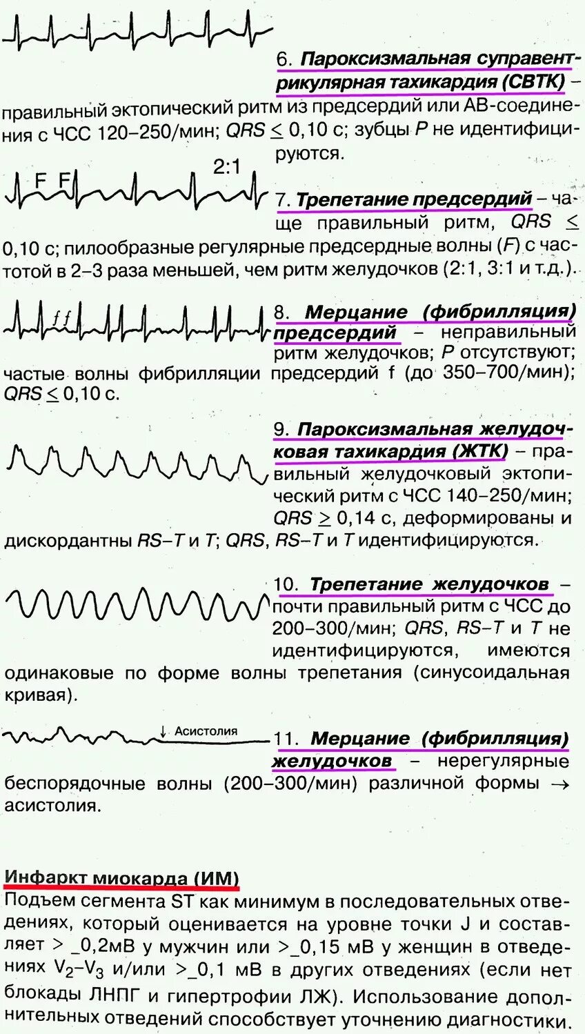 Электрография экг линия нормы экг. Экг патологии расшифровка. Пример нормальной экг с расшифровкой. Как прочитать кардиограмму. Экг норма расшифровка.