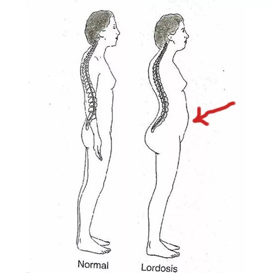 Кифоз + лордоз поясничного отдела позвоночника. Искривление позвоночника гиперлордоз. Искривление позвоночника поясничный лордоз. Лордоз поясничного отдела и гиперлордоз. Гиперлордоз и выпирающий живот
