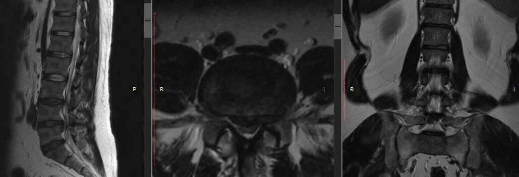 Невринома спинного мозга мрт. Дегенеративный спинальный стеноз l3-l4. Стеноз позвоночного канала l2-l3. Невринома позвоночника мрт. Крестцовый стеноз