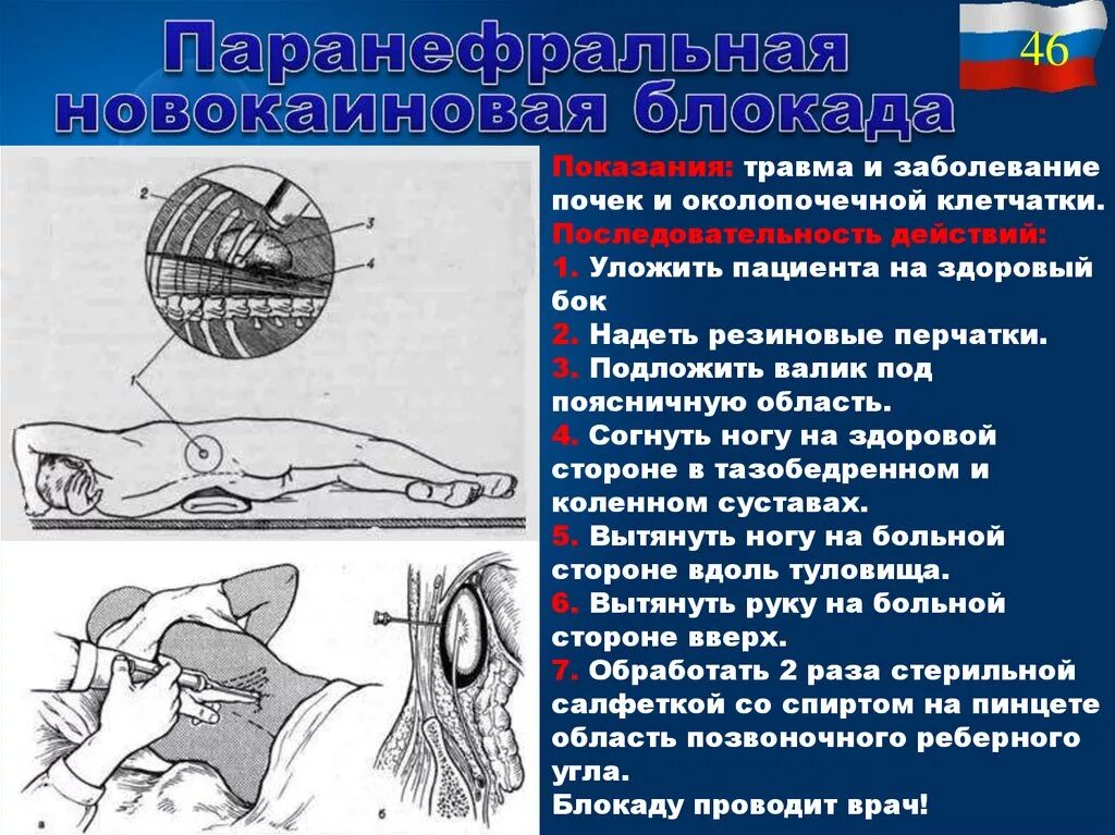 Блокада техника выполнения. Паранефральная блокада по Вишневскому. Техника поясничной паранефральной новокаиновой блокады. Методика проведения паранефральной блокады. 9. Паранефральная блокада по а.в. Вишневскому.