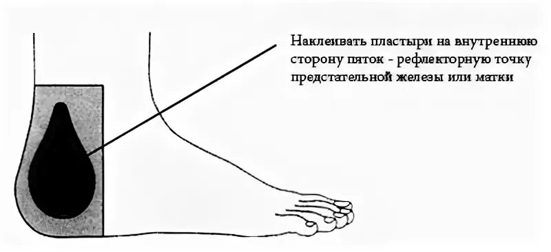 Точки рефлексов. Конусы для прогревания рефлексогенных точек. Пластырь нарисованный. Пластырь на точки для лечения почек.