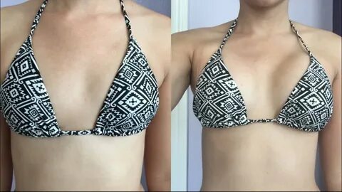 Breast, Boobs, Boob job, Breast augmentation, Surgery, Post-op, post op, Br...