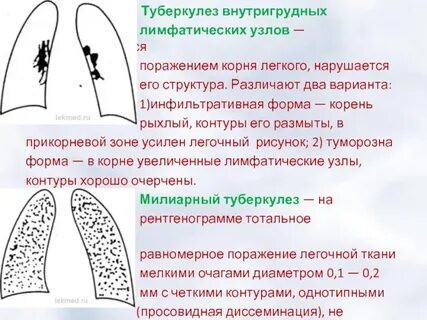 Туберкулез лимфоузлы легких