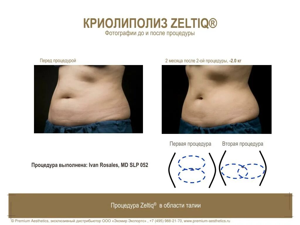 криолиполиз что это за процедура отзывы противопоказания