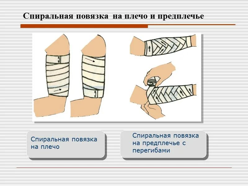 Спиральная повязка алгоритм