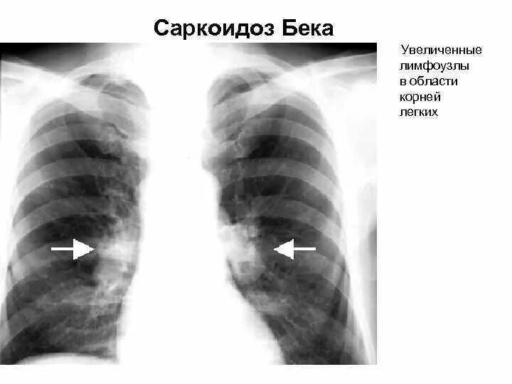 Увеличение корень легкого. Саркоидоз рентген грудной клетки. Саркоидоз внутригрудных лимфоузлов рентген. Саркоидоз легких 2 ст рентген. Саркоидоз флюорография.